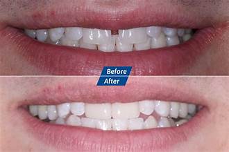 Root Canal Before and After